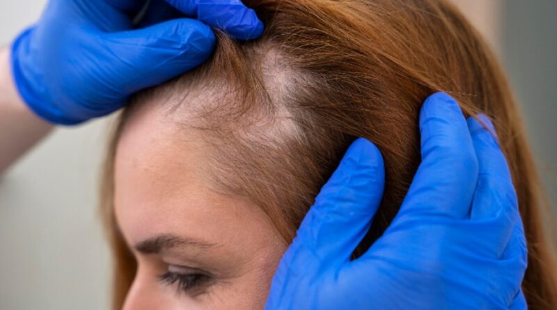How Hair Transplant Clinics Treat Female Hair Loss